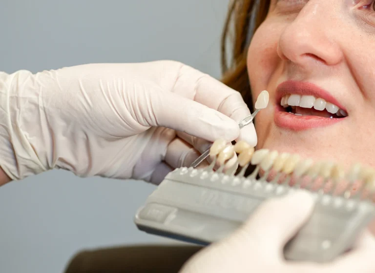 Quanto dura lo sbiancamento dentale