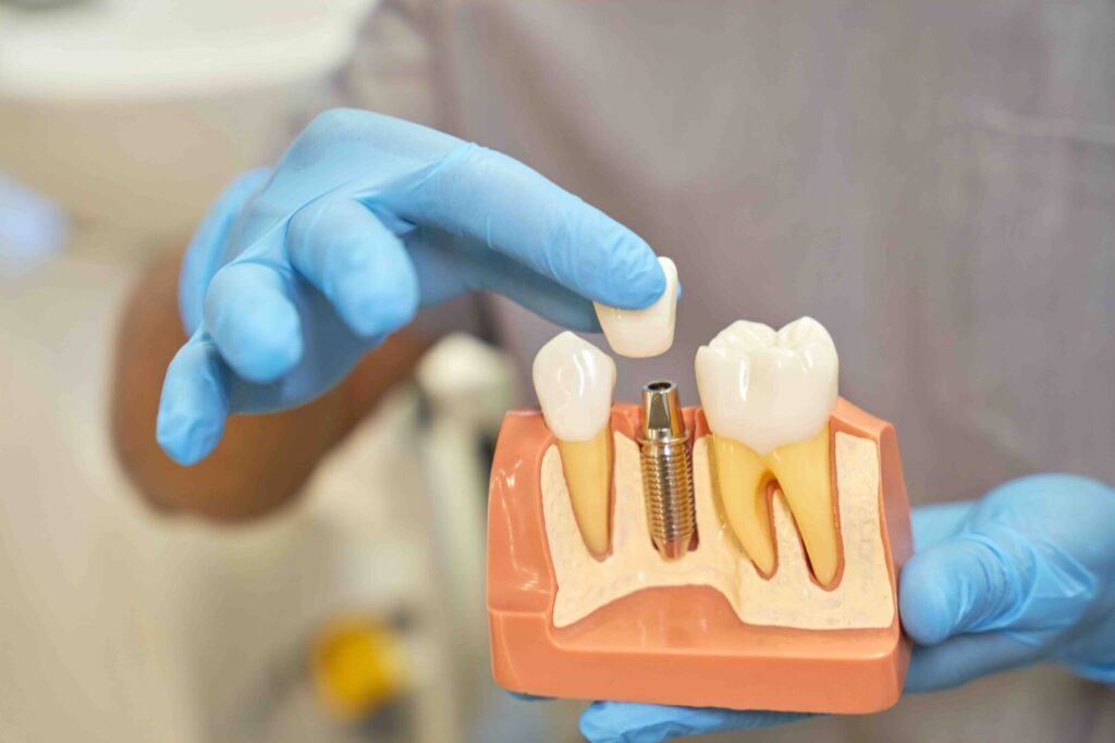 Impianto dentale fa male? 1 Impianto dentale fa male